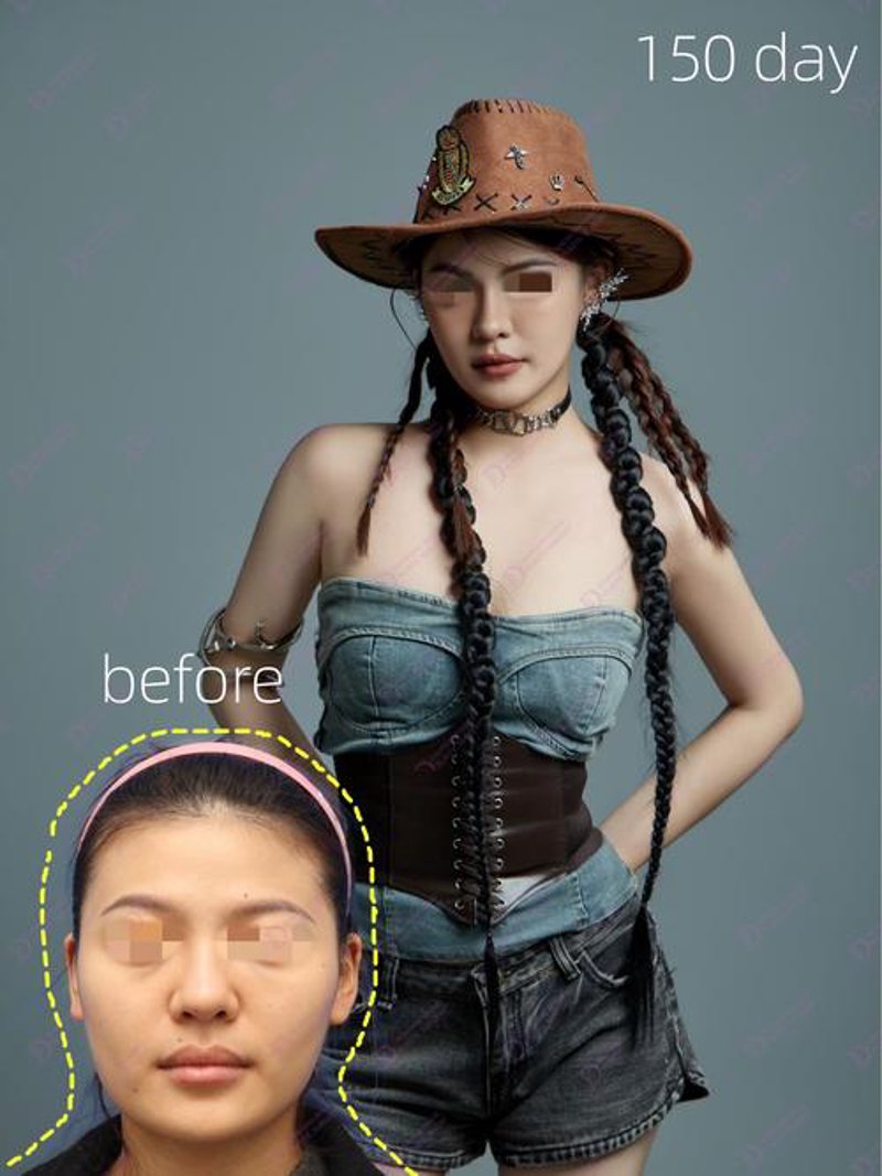 双眼皮手术：如何优雅地完成面部提升